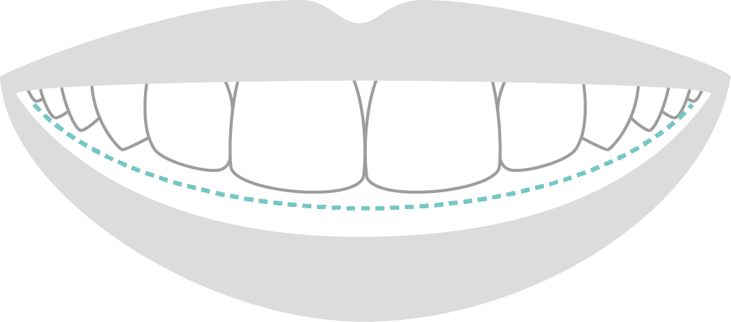 スマイルライン