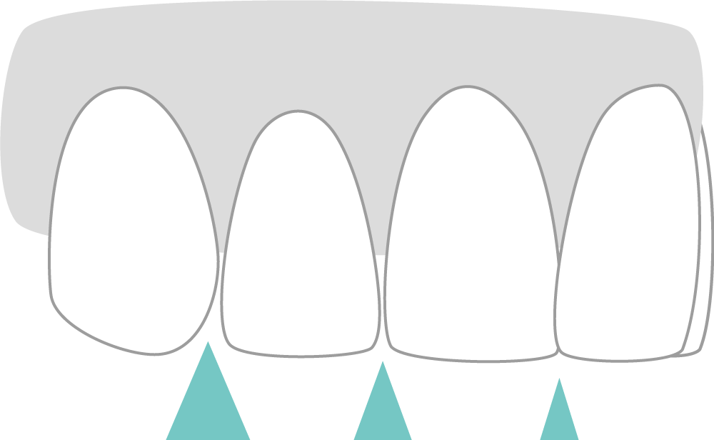 インサイザル・エンブレジャー