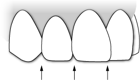 Incisal Embrasures
