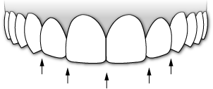 Incisal Embrasures